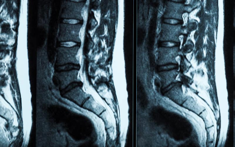 Image of Spine MRI